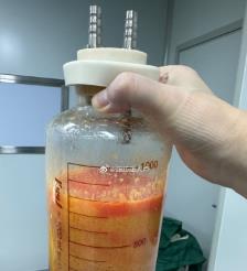 余姚水动力吸脂手术要做多久？